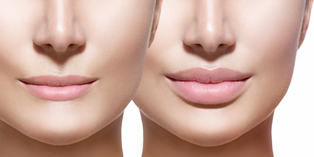 dermal-fillers-separet-page